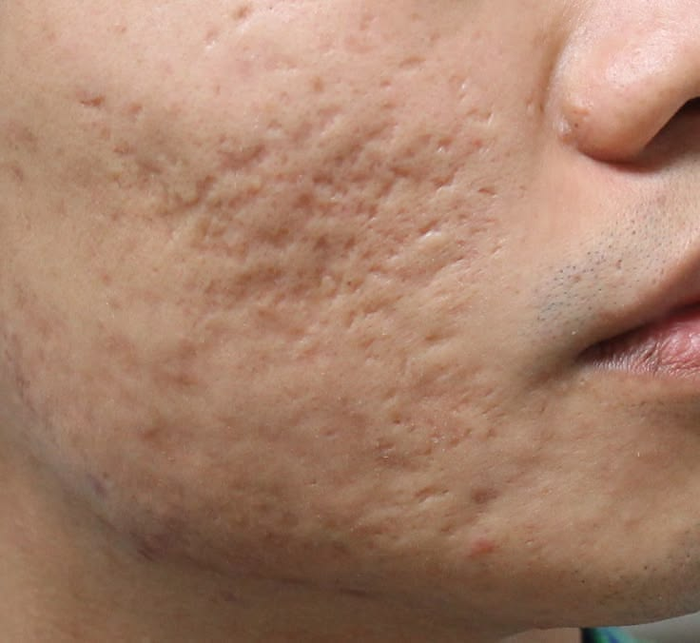 Acne & Acne Scarring