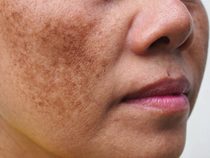 Pigmentation & Redness
