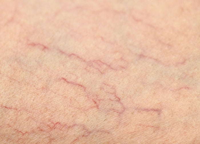 Spider Veins & Vascular Concerns